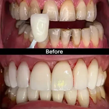 Teeth whitening