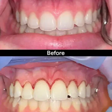 Veneers result