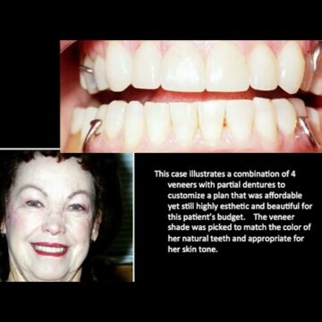 Treatment video