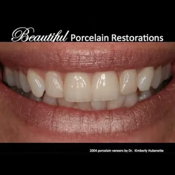 Smile makeover