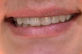 smile-1-a
